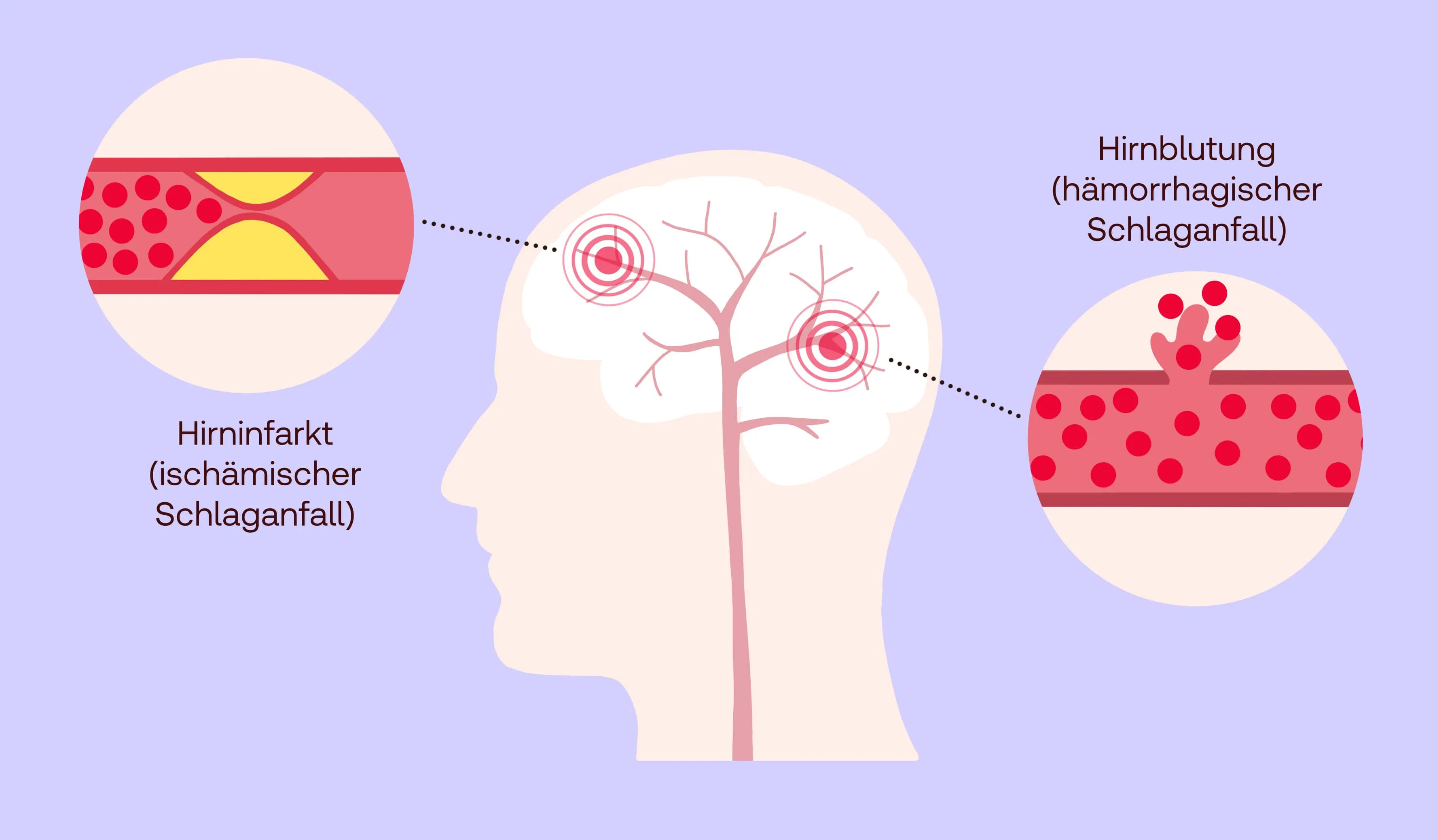 Gesundheitsinfos Schlaganfall